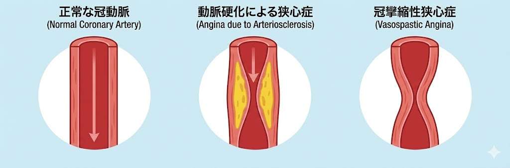 狭心症のメカニズム